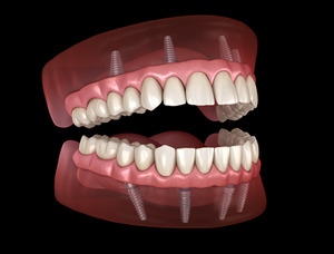 All-on-4 implants for upper and lower jaw